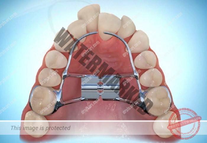 اکسپندر یا وسیع کننده کام چیست؟
