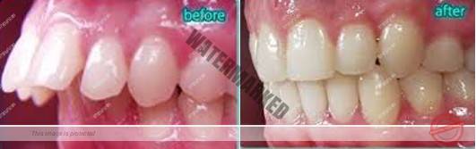 انواع مشکلات بایت (مال اکلوژن)