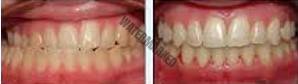 انواع مشکلات بایت (مال اکلوژن)