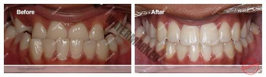 انواع مشکلات بایت (مال اکلوژن)