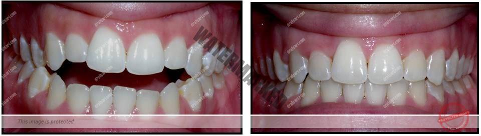 انواع مشکلات بایت (مال اکلوژن)