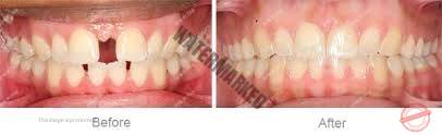 انواع مشکلات بایت (مال اکلوژن)