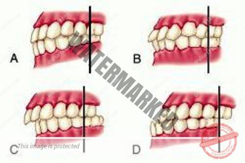 انواع مشکلات بایت (مال اکلوژن)